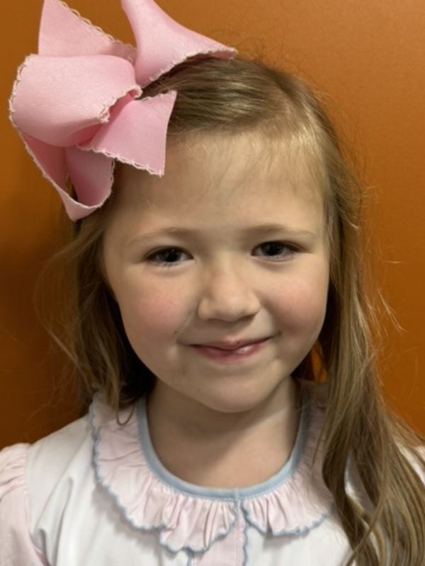A young girl a few years after surgery for craniosynostosis